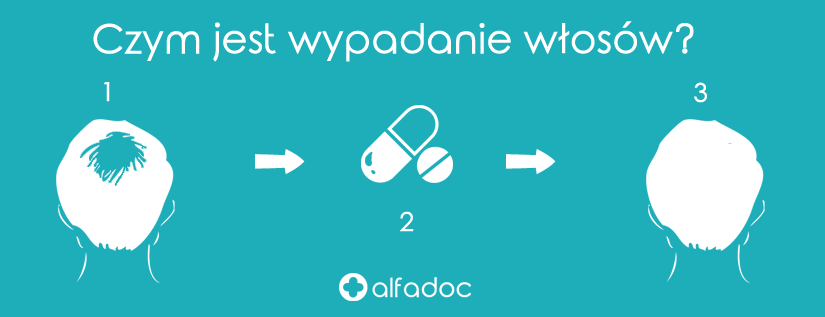 czym-jest-wypadanie-wlosow